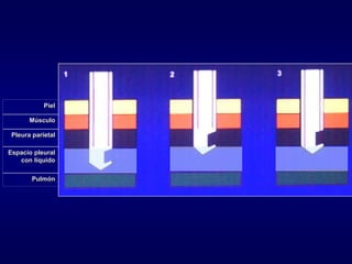 Piel
Músculo
Pleura parietal
Espacio pleural
con líquido
Pulmón
 