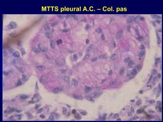MTTS pleural A.C. – Col. pas
 