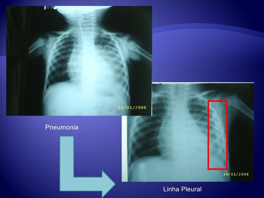 Pneumonia Com Derrame Pleural - RETOEDU