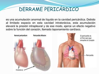 DERRAME PERICÁRDICO
es una acumulación anormal de líquido en la cavidad pericárdica. Debido
al limitado espacio en esta cavidad intratorácica, esta acumulación
elevará la presión intrapleural y de ese modo, ejerce un efecto negativo
sobre la función del corazón, llamado taponamiento cardíaco.
 