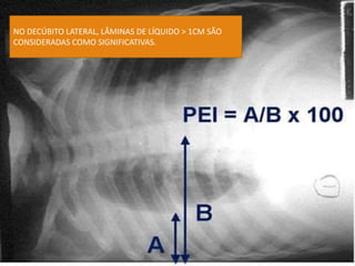 NO DECÚBITO LATERAL, LÂMINAS DE LÍQUIDO > 1CM SÃO
CONSIDERADAS COMO SIGNIFICATIVAS.
 