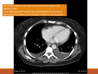NA TC DE TÓRAX É MELHOR VISUALIZADO NA JANELA DE
MEDIASTINO .
ÚTIL PARA QUANTIFICAÇÃO DO ESPESSAMENTO PLEURAL E
DE PLACAS PLEURAIS CALCIFICADAS, ALÉM DE LOCULAÇÕES.
 