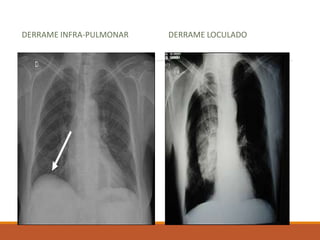DERRAME INFRA-PULMONAR DERRAME LOCULADO
 