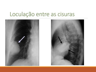Loculação entre as cisuras
 