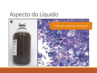 Aspecto do Líquido
Coloração enegrecida: Melanoma
 