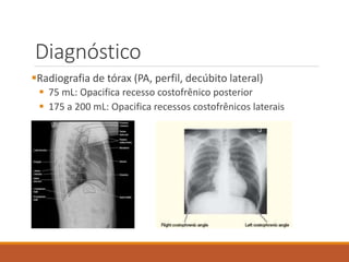 Diagnóstico
Radiografia de tórax (PA, perfil, decúbito lateral)
 75 mL: Opacifica recesso costofrênico posterior
 175 a 200 mL: Opacifica recessos costofrênicos laterais
 
