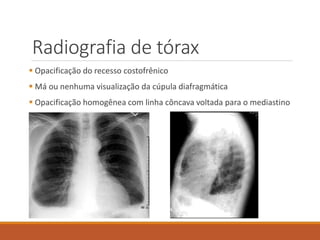 Radiografia de tórax
 Opacificação do recesso costofrênico
 Má ou nenhuma visualização da cúpula diafragmática
 Opacificação homogênea com linha côncava voltada para o mediastino
 