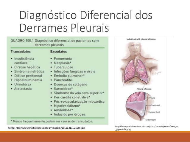 Derrames Pleurais