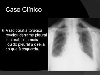 Caso Clínico
 A radiografia torácica
revelou derrame pleural
bilateral, com mais
líquido pleural à direita
do que à esquerda.
 