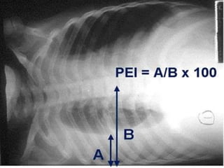 DERRAME PLEURALTEPPNEUMONIA