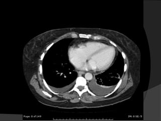 Avaliação InicialEstudos ultra-sonográficosRadiografias em decúbito lateral (Laurel)Tomografia Computadorizada (TC) para analisar o parênquima pulmonar subjacente ou mediastino.