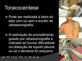 Indicações de ToracocenteseCerca de 75 % dos derrames causados por ICC resolvem-se dentro de 48 horas após estímulo da diurese. Se o derrame  persistir por mais de três dias, é indicado toracocentese. Light, RW. N Engl J Med, Vol. 346, No. 25