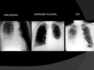Avaliação InicialTurgência jugular, ritmo em galope (B3) ou edema periférico sugerem insuficiência cardíaca congestiva.A presença de linfadenopatia ou hepatoesplenomegalia sugere doença neoplásica.Ascite pode sugerir um causa hepática.Presença de sinais de resposta inflamatória sistêmica (febre, taquicardia, taquipnéia) sugerem uma causa infecciosa subjacente.Light, RW. N Engl J Med, Vol. 346, No. 25