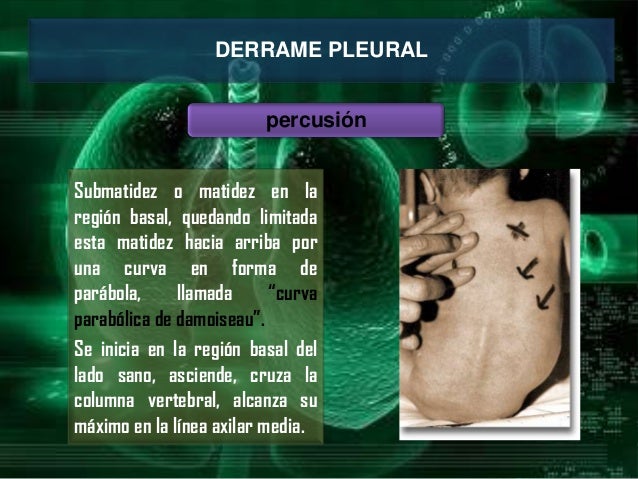 Derrame pleural