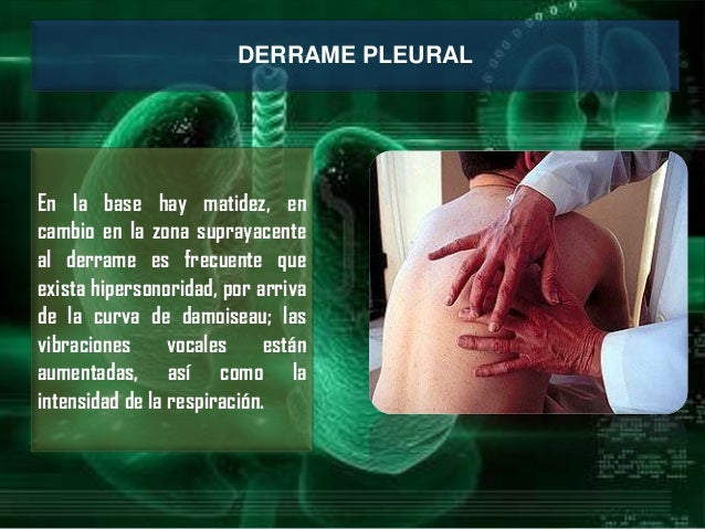 Derrame pleural