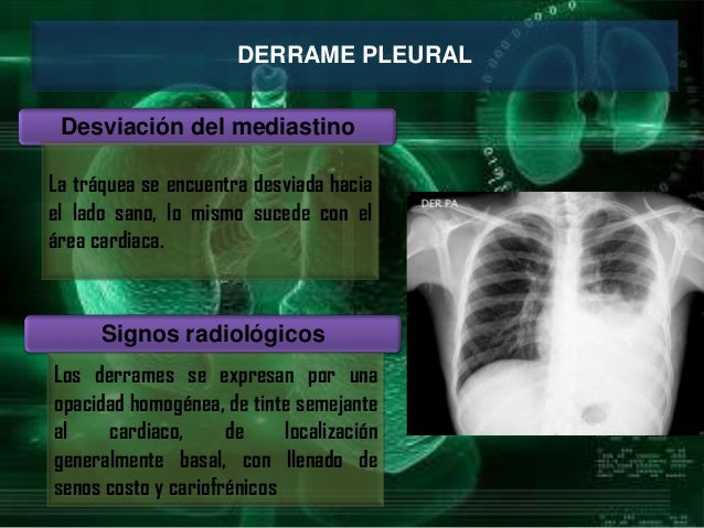 Derrame pleural