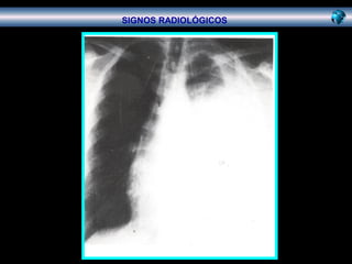 010
SIGNOS RADIOLÓGICOS
 