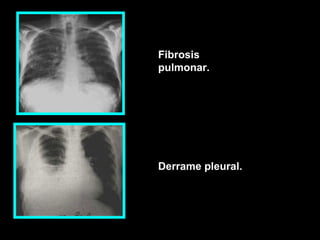 •
Fibrosis
pulmonar.
Derrame pleural.
 