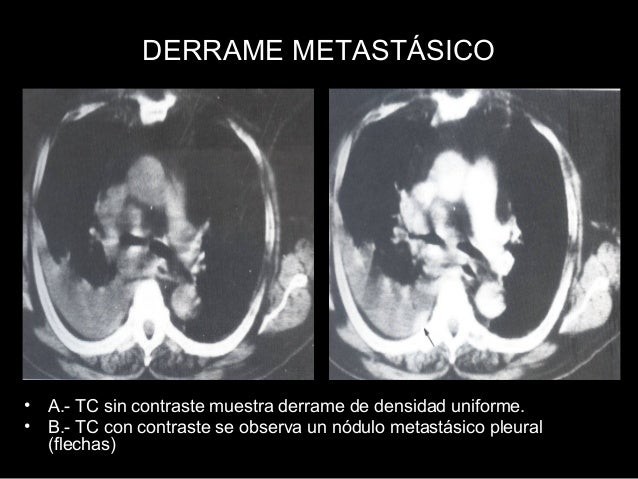 Resultado de imagen para ultrasonido de derrame pleural neoplasico