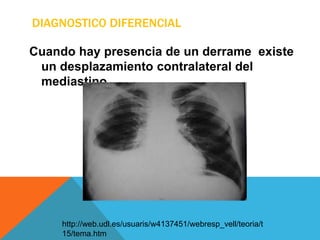DIAGNOSTICO DIFERENCIAL
Cuando hay presencia de un derrame existe
un desplazamiento contralateral del
mediastino.
http://web.udl.es/usuaris/w4137451/webresp_vell/teoria/t
15/tema.htm
 