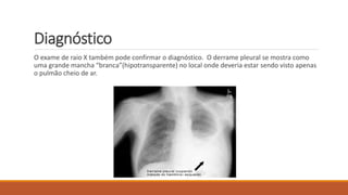Diagnóstico 
O exame de raio X também pode confirmar o diagnóstico. O derrame pleural se mostra como 
uma grande mancha “branca”(hipotransparente) no local onde deveria estar sendo visto apenas 
o pulmão cheio de ar. 
 