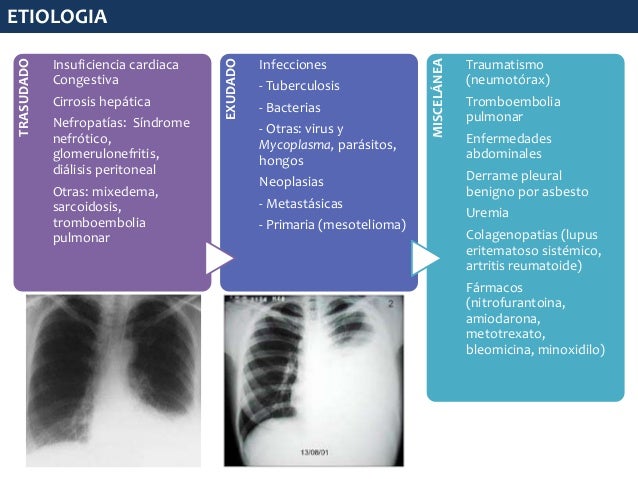 Derrame Pleural
