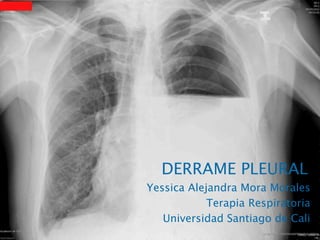 DERRAME PLEURAL
Yessica Alejandra Mora Morales
Terapia Respiratoria
Universidad Santiago de Cali
 