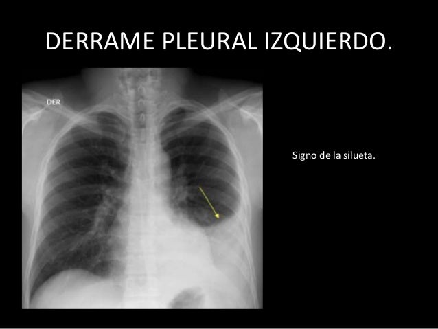 Resultado de imagen para radiografia de derrame pleural