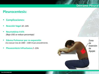 Derrame Pleural
Chest2014(146)(2):508
Pleurocentesis:
 Complicaciones:
 Reacción Vagal 10 -14%
 Neumotórax 4-6%
(Bajo USG se reduce porcentaje)
 Edema Pulmonar por re-expansión
(no evacuar mas de 1000 – 1500 ml por procedimiento.
 Pleuocentesis Infructuosa 2 -15%
 