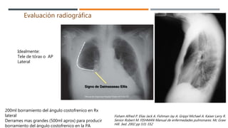 Evaluación radiográfica
Idealmente:
Tele de tórax o AP
Lateral
200ml borramiento del ángulo costofrenico en Rx
lateral
Derrames mas grandes (500ml aprox) para producir
borramiento del ángulo costofrenico en la PA
Fisham Alfred P. Elias Jack A. Fishman Jay A. Grippi Michael A. Kaiser Larry R.
Senior Robert M. FISHMAN Manual de enfermedades pulmonares. Mc Graw
Hill. 3ed. 2002 pp 531-552
 