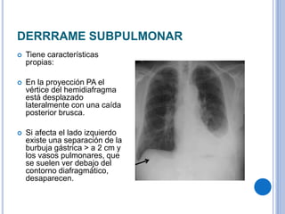 DERRRAME SUBPULMONAR
 Tiene características
propias:
 En la proyección PA el
vértice del hemidiafragma
está desplazado
lateralmente con una caída
posterior brusca.
 Si afecta el lado izquierdo
existe una separación de la
burbuja gástrica > a 2 cm y
los vasos pulmonares, que
se suelen ver debajo del
contorno diafragmático,
desaparecen.
 
