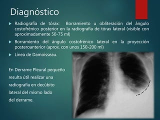 Diagnóstico
 Radiografía de tórax: Borramiento u obliteración del ángulo
costofrénico posterior en la radiografía de tórax lateral (visible con
aproximadamente 50-75 ml)
 Borramiento del ángulo costofrénico lateral en la proyección
posteroanterior (aprox. con unos 150-200 ml)
 Línea de Damoisseau.
En Derrame Pleural pequeño
resulta útil realizar una
radiografía en decúbito
lateral del mismo lado
del derrame.
 
