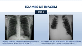 EXAMES DE IMAGEM
RAIO-X
http://www.ncpba.com.br/portal/index.php?site=2&modulo=ev
a_conteudo&co_cod=45. Acesso em 02/04/2017 às 23:43.
https://pt.slideshare.net/flaviasmatos/radiografia-normal-
do-trax-7023018. Acesso em 02/04/2017 às 23:43.
 