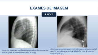 EXAMES DE IMAGEM
RAIO-X
http://www.pneumoimagem.com.br/imagens_pneumo_detalh
e.asp?idcat=39&imagem=147#.WOGuZ2_yvIU.Acesso em
02/04/2017 às 23:43.
https://pt.slideshare.net/flaviasmatos/radiografia-normal-do-
trax-7023018. Acesso em 02/04/2017 às 23:43.
 