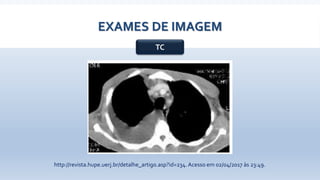 EXAMES DE IMAGEM
TC
http://revista.hupe.uerj.br/detalhe_artigo.asp?id=234. Acesso em 02/04/2017 às 23:49.
 
