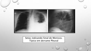 Setas indicando Sinal de Menisco.
Típico em derrame Pleural
 