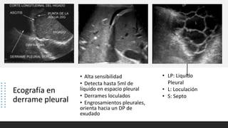 Ecografía en
derrame pleural
• Alta sensibilidad
• Detecta hasta 5ml de
líquido en espacio pleural
• Derrames loculados
• Engrosamientos pleurales,
orienta hacia un DP de
exudado
• LP: Liquido
Pleural
• L: Loculación
• S: Septo
 