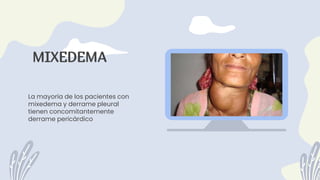La mayoría de los pacientes con
mixedema y derrame pleural
tienen concomitantemente
derrame pericárdico
MIXEDEMA
 