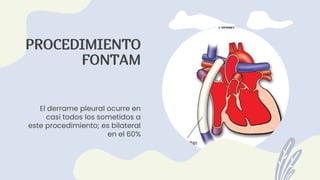 El derrame pleural ocurre en
casi todos los sometidos a
este procedimiento; es bilateral
en el 60%
PROCEDIMIENTO
FONTAM
 