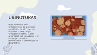 Habitualmente, hay
antecedentes de patología
neoplásica renal o de vías
urinarias o bien cirugía
urológica reciente. El olor
amoniacal del trasudado y el
cociente creatinina
pleura/suero >1 contribuyen al
diagnóstico.
URINOTORAX
 