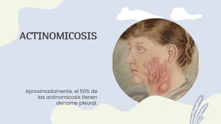 ACTINOMICOSIS
Aproximadamente, el 50% de
las actinomicosis tienen
derrame pleural.
 