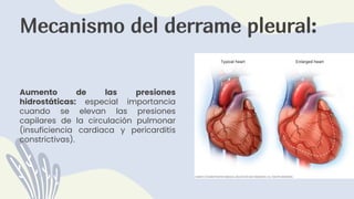 Mecanismo del derrame pleural:
Aumento de las presiones
hidrostáticas: especial importancia
cuando se elevan las presiones
capilares de la circulación pulmonar
(insuficiencia cardiaca y pericarditis
constrictivas).
 
