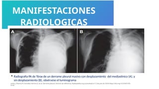 MANIFESTACIONES
RADIOLOGICAS
 Radiografía PA de Tórax de un derrame pleural masivo con desplazamiento del mediastinico (A), y
sin desplazamiento (B), obsérvese el luminograma
jones J, Sharma R, González Herrera G, et al. Derrame pleural. Artículo de referencia, Radiopaedia.org (consultado el 12 de julio de 2024) https://doi.org/10.53347/rID-
6159
 