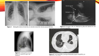 Figura 2. Radiografía de tórax
lateral, se aprecia signo del
menisco.
Figura 3. Imagen de un derrame pleural derecho en
una ecografía.
Figura 4. Tomografía computarizada que muestra un
 