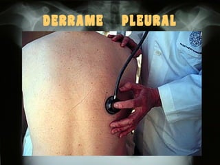 DERRAME

PLEURAL

 