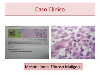Caso Clínico




Mesotelioma Fibroso Maligno
 