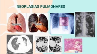 NEOPLASIAS PULMONARES
 