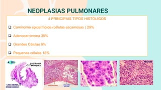 NEOPLASIAS PULMONARES
4 PRINCIPAIS TIPOS HISTÓLIGOS
❑ Carninoma epidermóide (células escamosas ) 29%
❑ Adenocarcinoma 35%
❑ Grandes Células 9%
❑ Pequenas células 18%
 