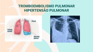 TROMBOEMBOLISMO PULMONAR
HIPERTENSÃO PULMONAR
 