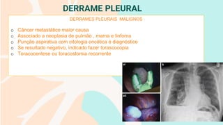 DERRAME PLEURAL
DERRAMES PLEURAIS MALIGNOS
o Câncer metastático maior causa
o Associado a neoplasia de pulmão , mama e linfoma
o Punção aspirativa com citologia oncótica é diagnóstico
o Se resultado negativo, indicado fazer torascocopia
o Toracocentese ou toracostomia recorrente
 